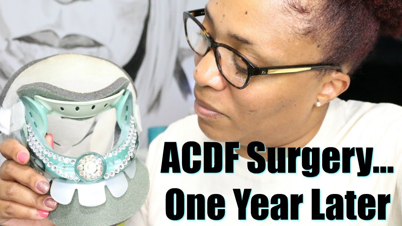 ACDF Surgery One Year Later Scar Photos YouTube