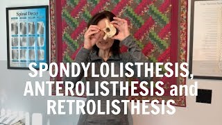 Spondylolisthesis, anterolisthesis and retrolisthesis explained by Irvine Chiropractor