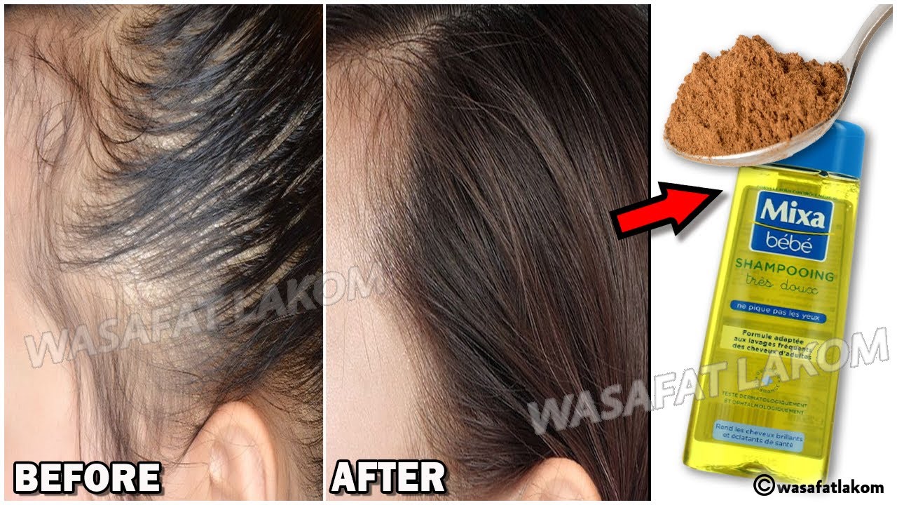 Put This Ingredients In Your Shampoo It Speeds Up Hair Growth And Treats Baldness Youtube