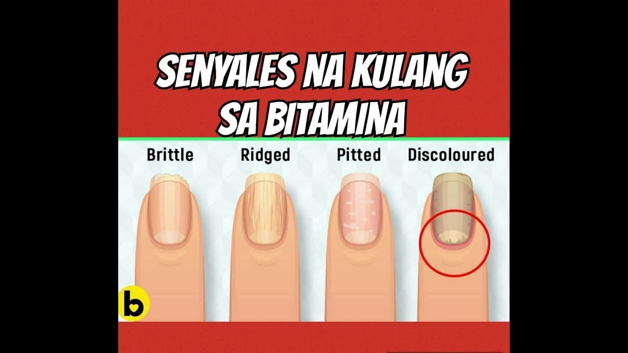 5 Senyales Kulang Ka sa Bitamina - Payo ni Doc Willie Ong #761