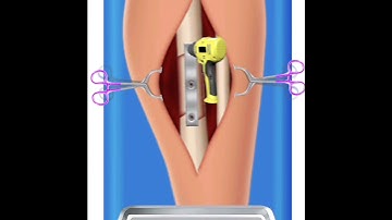 Leg Amputation Surgery 3D animation #shorts #shortsvideo #viralshorts