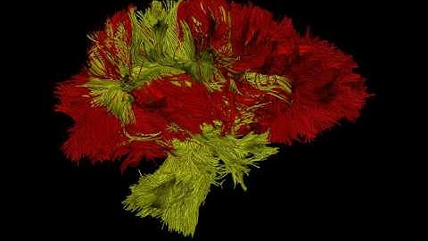 Tractography of corpus callosum and internal capsule