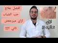 افضل علاج حب الشباب ازاي نعالجه وميرجعش تاني