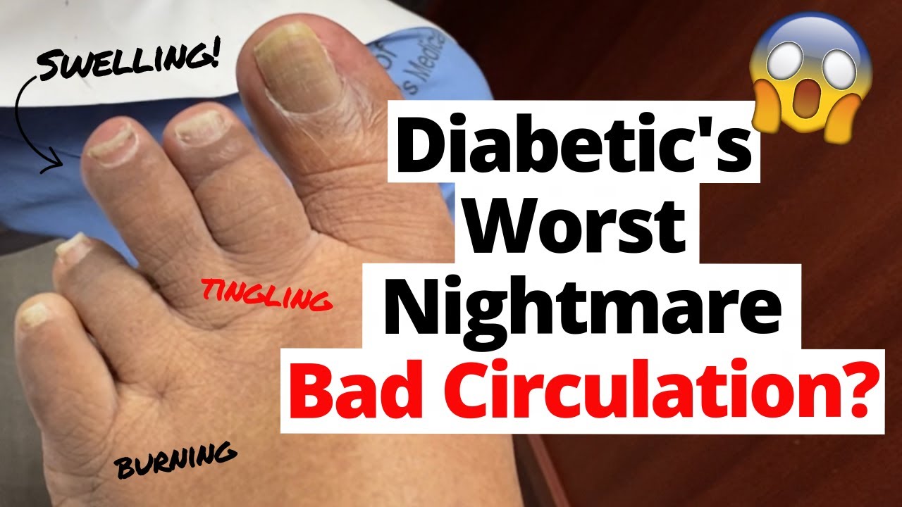 Swollen Diabetic Foot From Circulation Issue Youtube