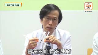 中大中期肝癌新療法　延長無惡化存活期2倍