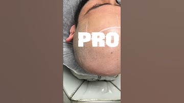 Scalp Micropigmentation 1st Session Results. #shorts #scalpmicropigmentation