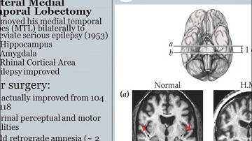 Learning, Memory, Amnesia