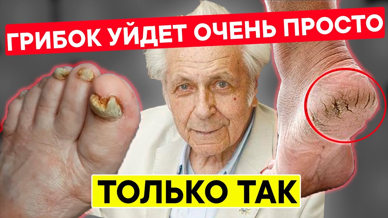 Неумывакин: ГРИБОК Уйдет Даже Не Заметишь! Только так От грибка ногтей ...