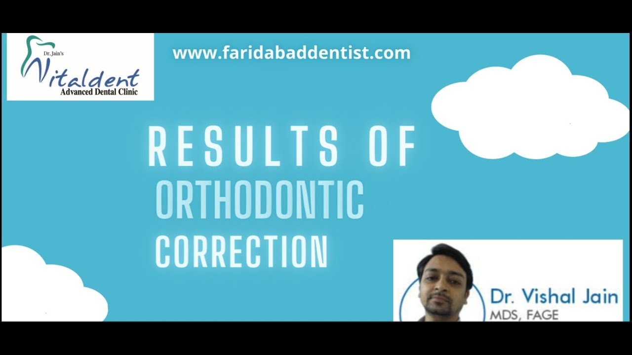 Result of Orthodontic tooth Correction - Dr Vishal Jain