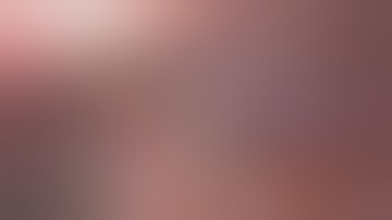 Complicated(perforated) appendicitis in a child- Laparoscopic Management