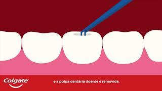 Tratamento de Canal Radicular | Colgate®