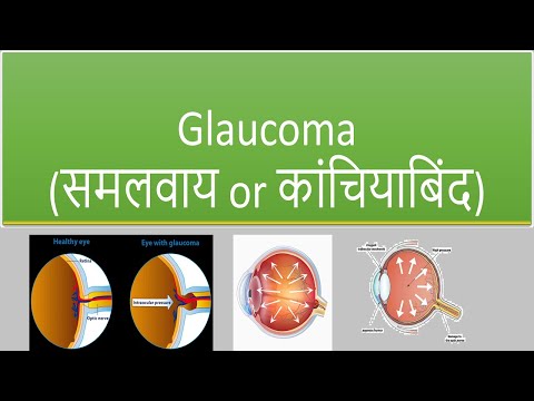 Glaucoma (समलबाई या ग्लूकोमा)