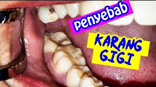 Kebiasaan Ini Menyebabkan Gigi Karang Kuning Scaling Membersihkan Karang Gigi Di Dokter Gigi Jogja Kebiasaan Ini Menyebabkan Gigi Karang Kuning Scaling Membersihkan Karang Gigi Di Dokter Gigi Jogja