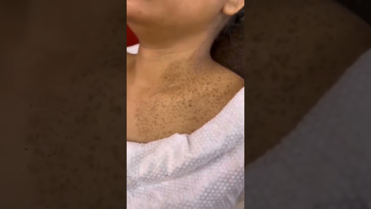 How to Cover a Birthmark With Makeup