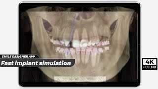 Fast Implant Simulation | Smile Designer App (4K) screenshot 4