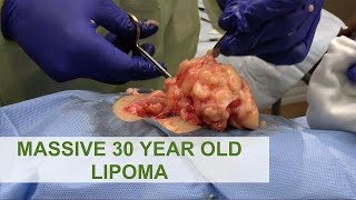 Massive 30 Year Old Lipoma | Dr. Derm