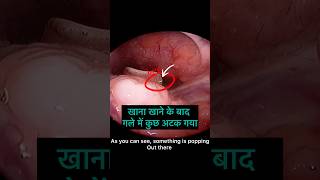 Download Lagu Iets in de keel vast na een maaltijd. #Buitenlandslichaamkeel MP3