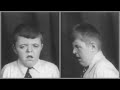 Hypertelorism and Oxycephaly. 1950s medical documentary on &quot;Feebleminded&quot;