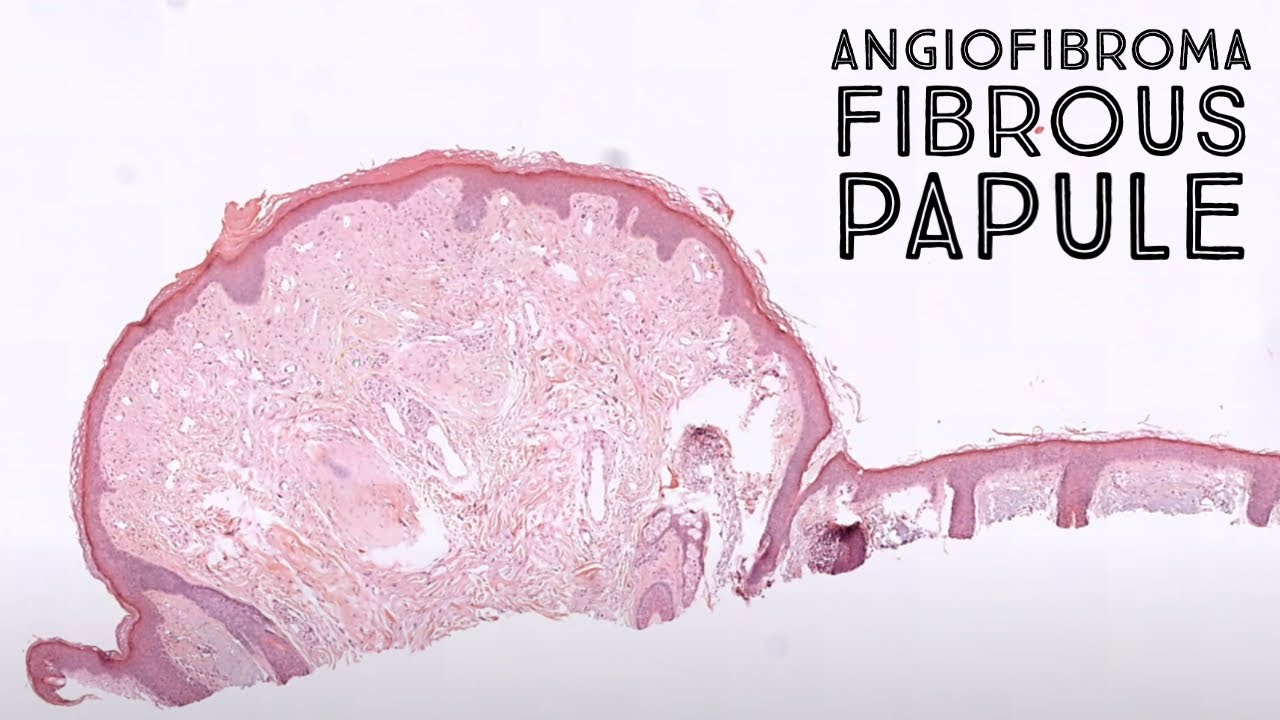 Angiofibroma Fibrous Papule Clinical Mimic Of Basal Cell Carcinoma