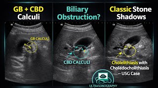 “Gallbladder Stones with CBD Stones — Cholelithiasis & Choledocholithiasis on Ultrasound” 