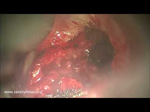 Partial Arytenoidectomy Prof Taner Yılmaz Application 2 