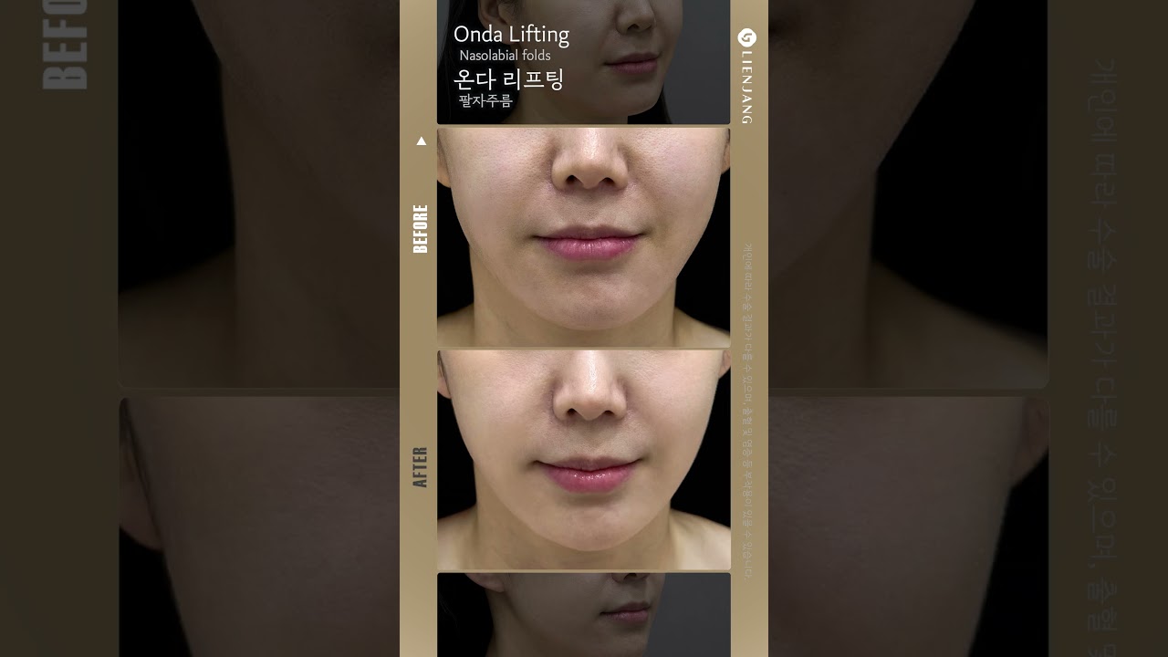 [Лиенжанг гоо сайхны мэс заслын эмнэлэг] Онда лифтинг хамар уруулын үрчлээ