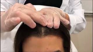 Como Aplicar o Minoxidil da maneira correta