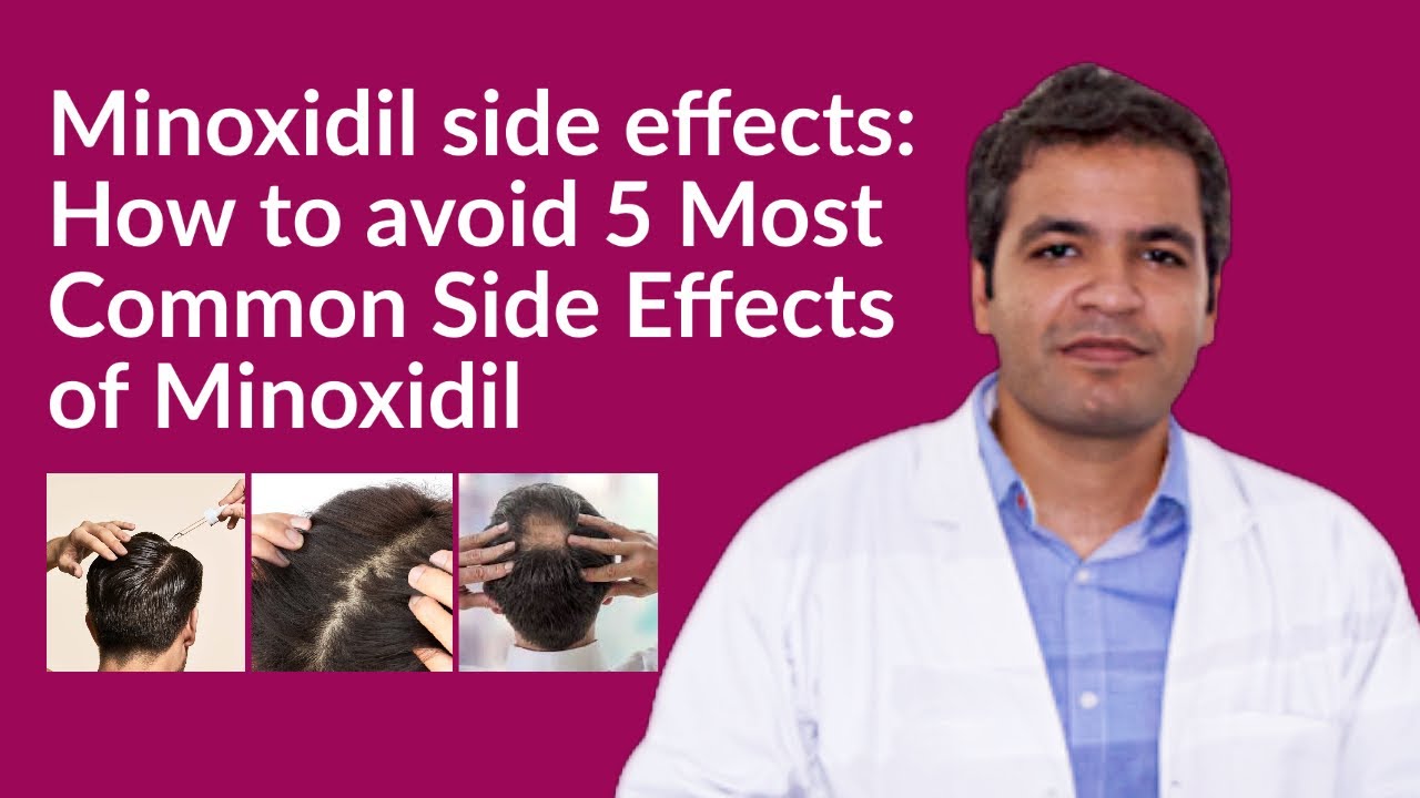 Saml op Uheldig Egypten Minoxidil side effects: How to avoid Minoxidil side effects | 5 Common Side  Effects of Minoxidil - YouTube