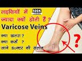 Varicose Veins Treatment In Hindi, Causes, Complications, Treatment, LASER Surgery, blood Clot Leg