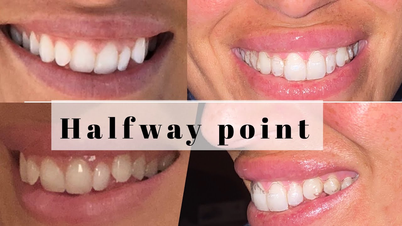 INVISALIGN HALFWAY POINT RESULTS & COMPARISON TIME! BEFORE & AFTER