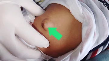 ¿Es frecuente la hernia umbilical en los bebés?