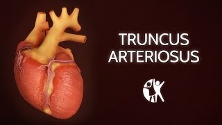 Truncus Arteriosus