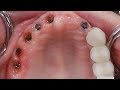 Best Restoration for a Heavy Bruxer | Metal Lingual Full Arch