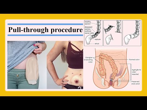 Video: Wat is endorectale pull-through?