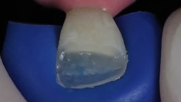 Composite bonding and tooth reconstruction using IPS Empress Direct from Ivoclar