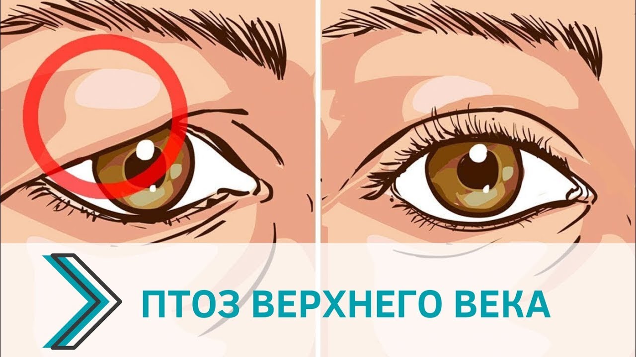 Птоз верхнего века это. Птоз верхнего века причины.