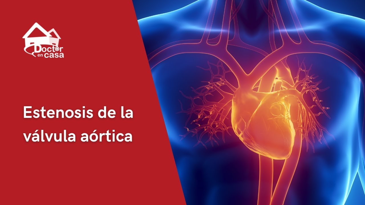 Estenosis de la válvula aortica - YouTube