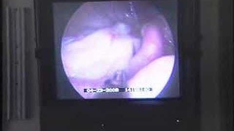 Cutting Edge Technology Lessens Pain of Surgery