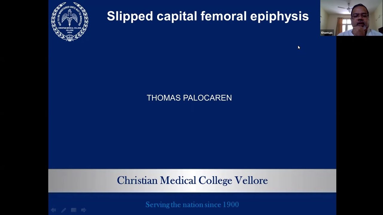 TO PASS DNB MS ORTHOPAEDICS CASE 99 SCFE SLIPPED CAPITAL FEMORAL to-pass-dnb-ms-orthopaedics-case-99-scfe-slipped-capital-femoral
