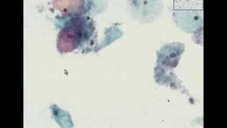 Histopathology CervixBacterial vaginosis