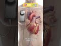 🎯Implantable Cardioverter Defibrillator 🩺🏥#lifeinicu #drarchanasinha  @Life_in_ICU_yt 👈Subscribe