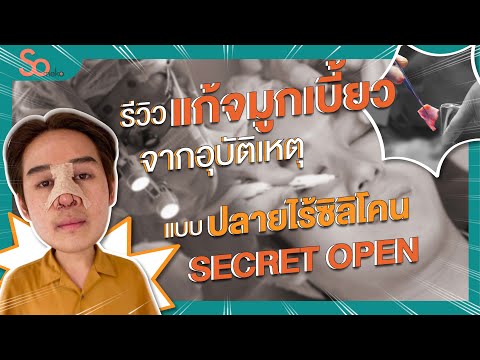 จมูกเบี้ยวเพราะอุบัติเหตุต้องแก้ไขเสริมจมูกปลายไร้ซิลิโคน Secret Open ที่ someko