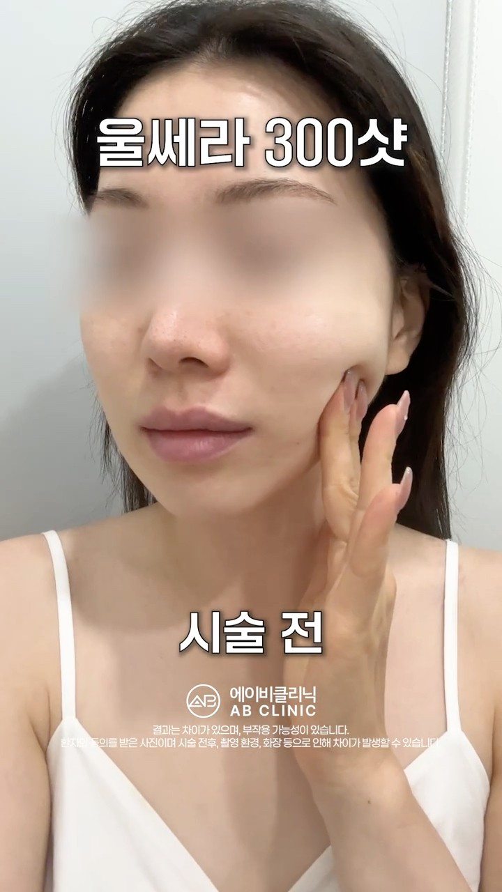 울쎄라 300샷 효과는 어떨까?