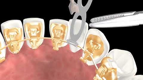 Incognito™ Appliance System Clinical Guide 07:  Lasso Elastic (O Lasso)