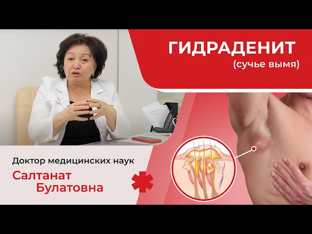 Гидраденит: причины, симптомы, лечение