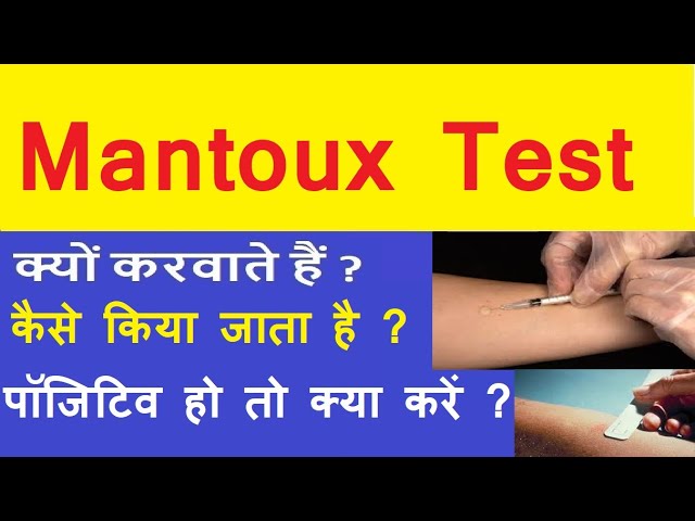 Mantoux Test In Hindi Mantoux Test Procedure In Hindi Mantoux Test Positive Ho To Kya Karein Youtube