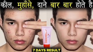 कल, महस, दन बर बर हत ह ? Erytop Gel Review