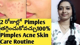 Pimples Acne Removal on Face at Home in Telugu/How To get rid of Pimples/Pimples removal cream telgu