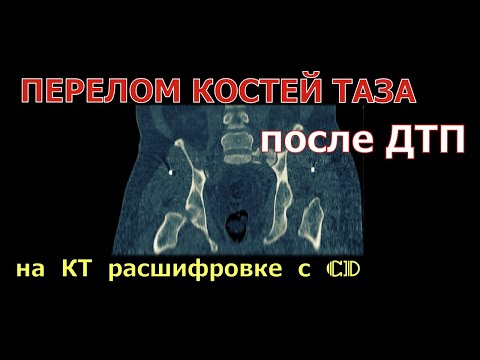 ПЕРЕЛОМ КОСТЕЙ ТАЗА включая перелом крестца и перелом седалищной кости на расшифровке КТ