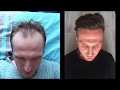 Hair transplant with 4360 grafts manual fue  two surgeries sessions at a difference of 8 years